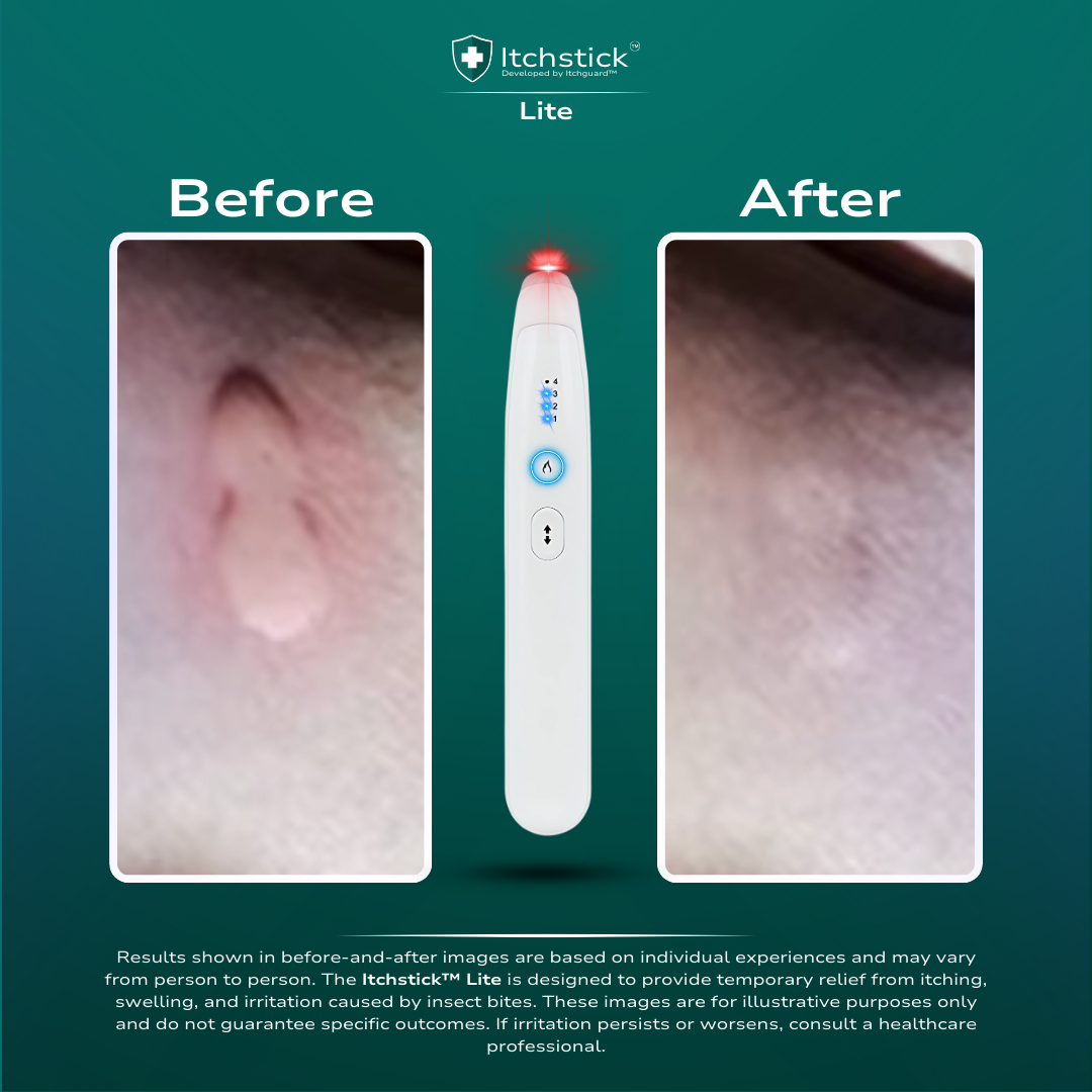 Itchstick™ Lite - Electronic Bite Relief Pen